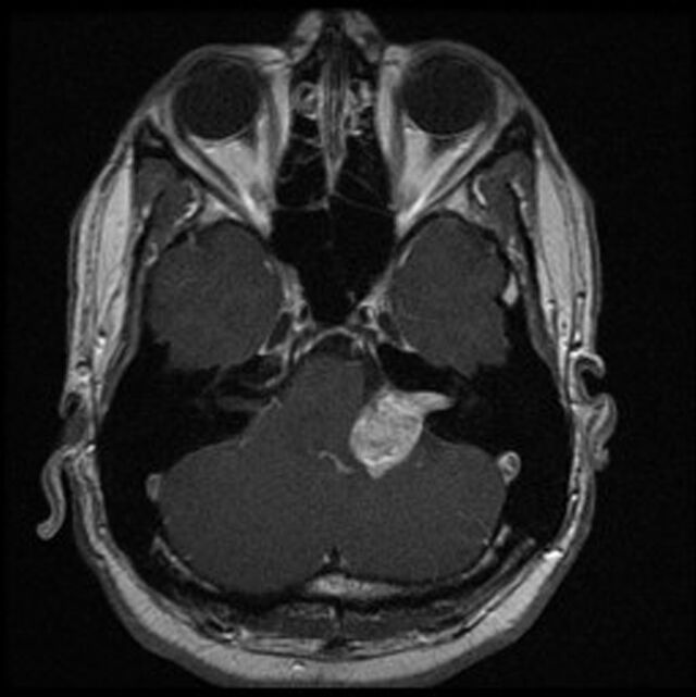 MRT eines Akustikus Neurinoms / Vestibularisschwannoms MRT eines Akustikus Neurinoms / Vestibularisschwannoms